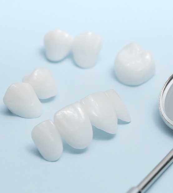 Different types of porcelain veneers and Lumineers prior to placement