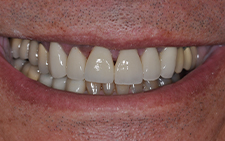 Front view of beautiful smile after dental treatment