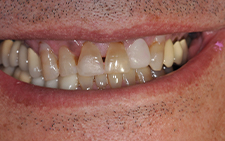 Front view of damaged smile before dental treatment