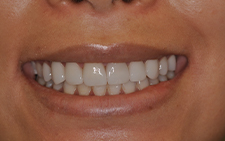 Full smile after dental treatment