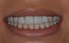 Full smile before dental treatment