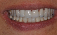 Smile with new natural looking dental restorations