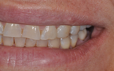Left side view of smile after replacing missing tooth