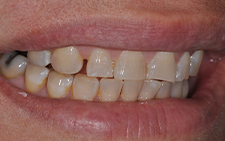 Right side view of smile with large gaps before orthodontics