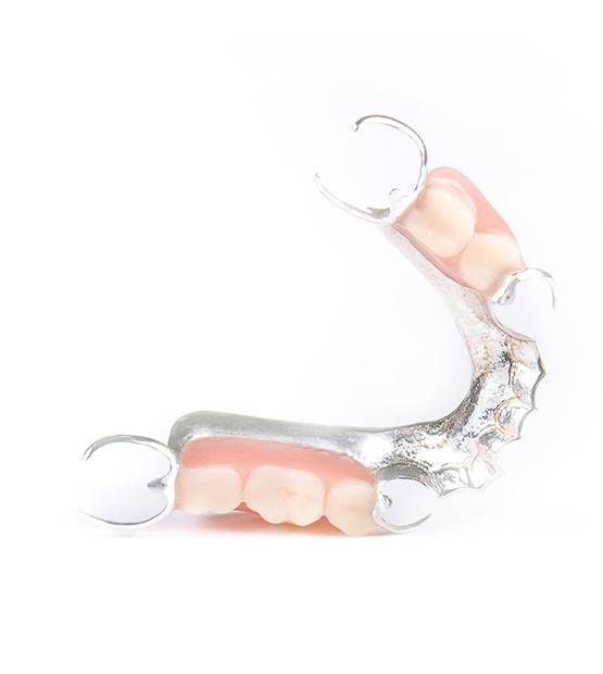 Partial denture with metal frame