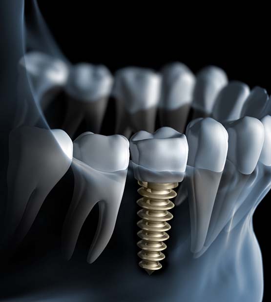 X-ray diagram of dental implants in Flower Mound
