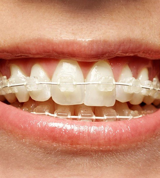 Teeth with six month smiles ceramic braces