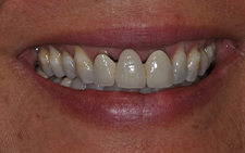 Smile with unnatural looking dental restorations