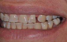 Left side view of smile with missing tooth