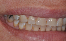 Right side view of smile aligned by orthodontic treatment