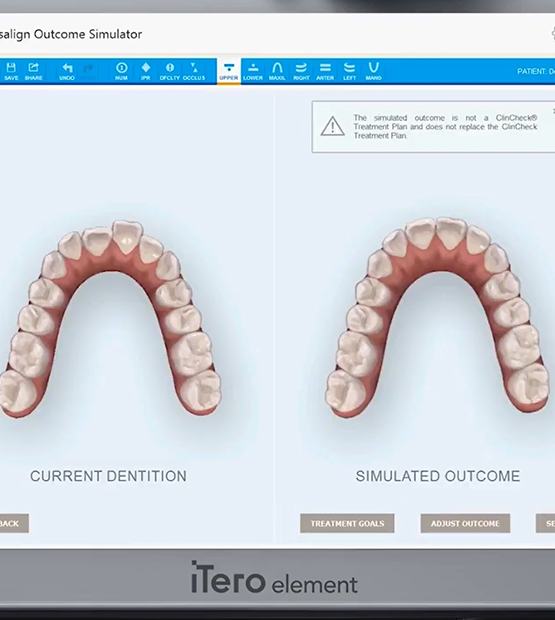 iTero smile makeover simulation on computer screen