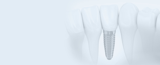 Dental implant consultation special coupon