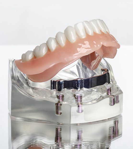 Model implant retained denture
