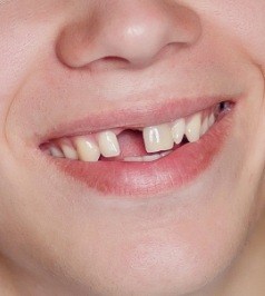 Smile with missing front tooth