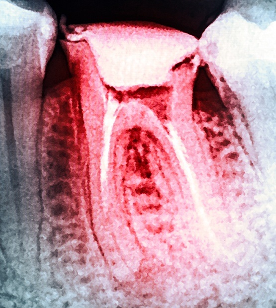 X-ray of damaged tooth that needs to be extracted