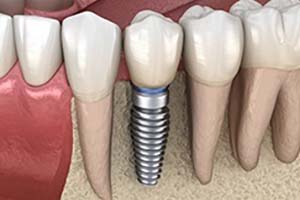 Digital model of a single tooth dental implant in Flower Mound