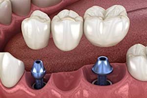 Digital diagram showing implant bridge replacing multiple missing teeth in Flower Mound