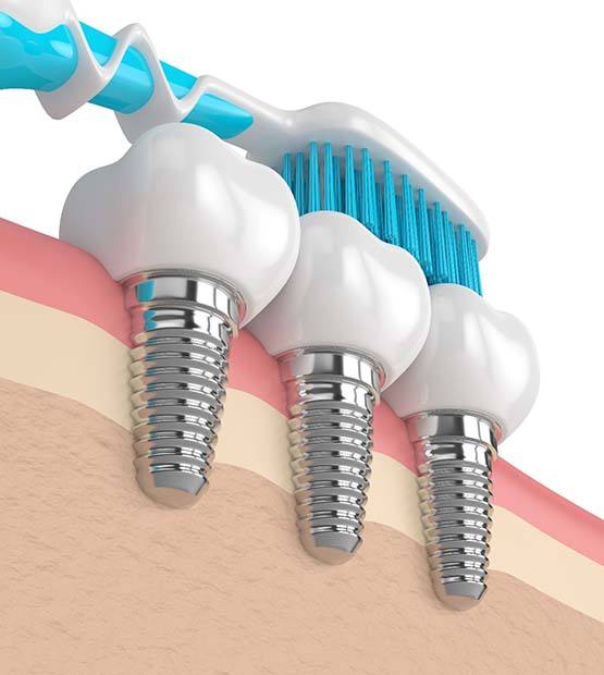 Diagram showing how to care for dental implants in Flower Mound