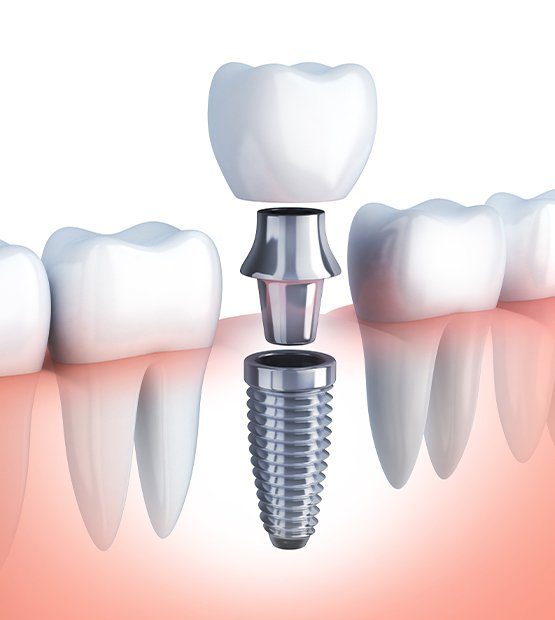 Animated dental implant tooth replacement process