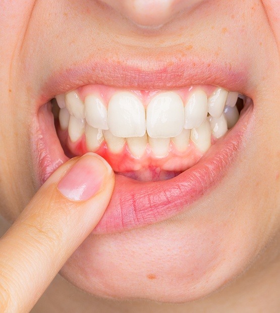 Patient with gum disease pointing to swollen soft tissue