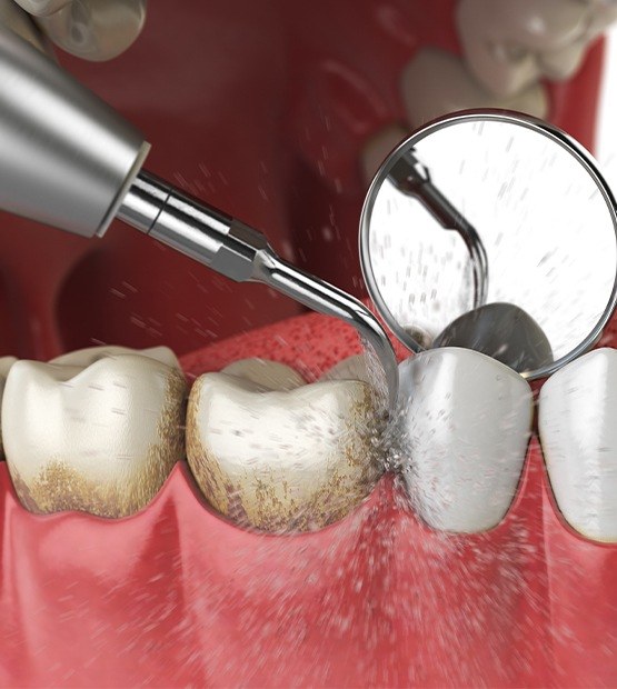 Animated deep cleaning process for gum disease