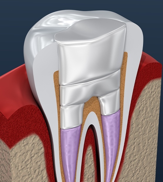 Animated tooth after root canal therapy