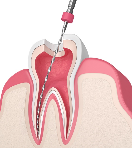Animated tooth receiving endodontic retreatment