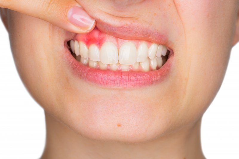 woman with gum disease in Flower Mound pointing to gums 