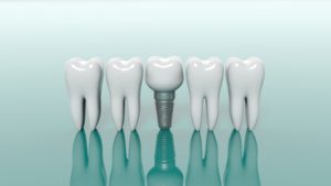 Dental implant replacing tooth